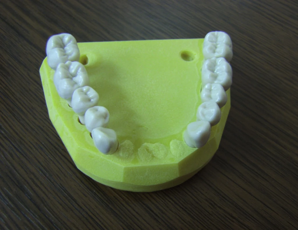 Zuby zasazené v „odublovaném“ modelu.