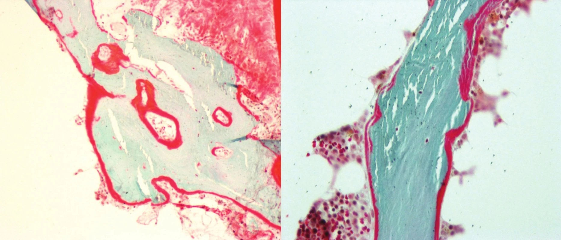 Histomorfometrie kostní tkáně (Goldner 10x, osteoid červeně, kostní trámce modře)