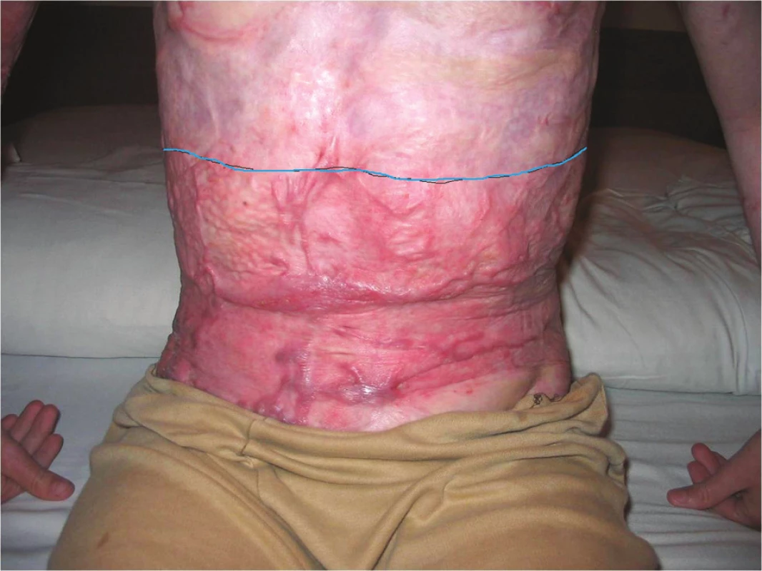 Kosmetický efekt Integry&lt;sup&gt;®&lt;/sup&gt; – dvanáctiletý chlapec půl roku po popáleninovém traumatu s následnou transplantací kůže (v kraniální části trupu byla použita Integra&lt;sup&gt;®&lt;/sup&gt;, v kaudální části jen DE štěpy)
