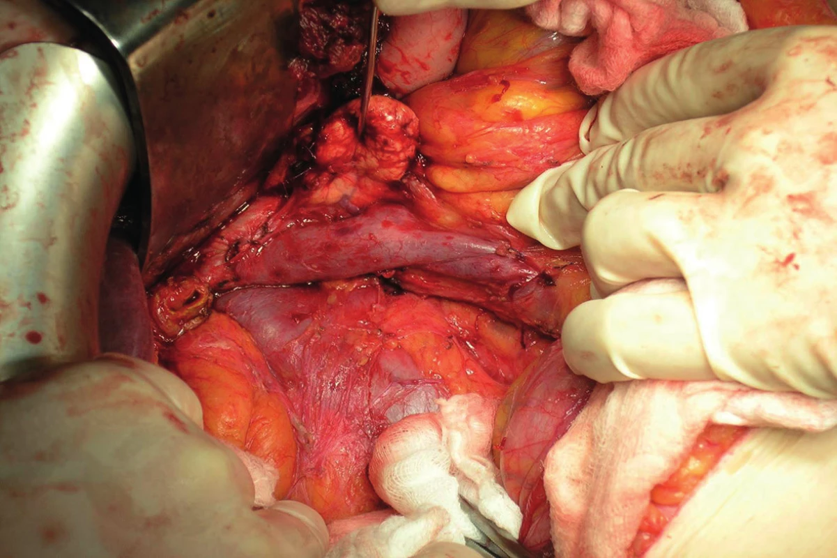 Post pancreatoduodenectomy and standard lymphadenectomy (intraoperative photo)