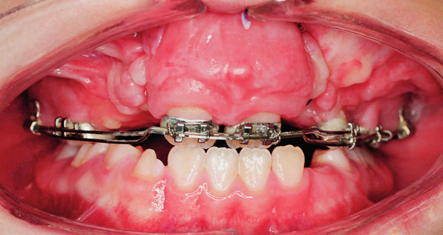 Teeth of the patient with fixed appliance and thick postsurgical immobility wire three weeks after surgical repositioning of premaxilla