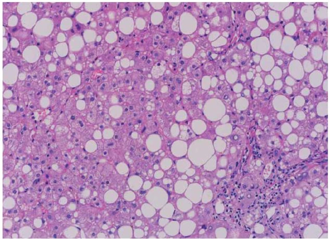 Typický histologický obraz NASH (hemoatoxylin-eozin). Je patrná steatóza, balooning hepatocytů a fibróza. (Laskavě zapůjčeno as. MUDr. J. Stříteským, CSc. – Patologicko-anatomický ústav, 1. LF UK v Praze).
Fig. 1. The typical histological picture of NASH (hematoxylin-eosin). Mixed steatosis, ballooning hepatocytes and fibrosis are evident. (Courtesy of J. Stříteský, MD, PhD. – Department of Pathology and Anatomy, 1&lt;sup&gt;st&lt;/sup&gt; Faculty of Medicine, Charles University in Prague).
