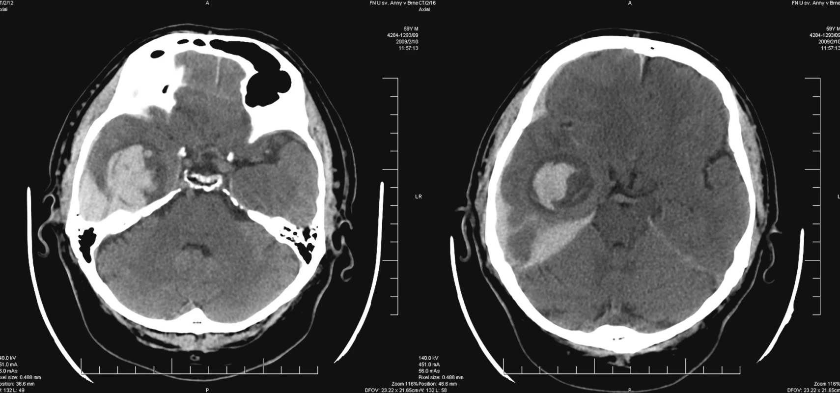 CT obraz intracerebrálního hematomu v hloubce temporálního laloku vpravo s provalením subdurálně
Pic. 1. CT – intracerebral haematoma in the depth of temporal lobe with subdural penetration