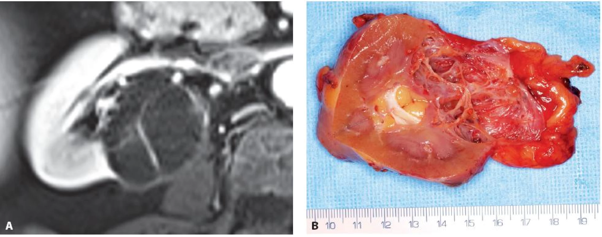 Multicystický světlobuněčný renální karcinom zadního rtu pravé ledviny. A – MRI, B – nativní preparát
Fig. 5. Multicystic clear cell renal cell carcinoma. A – MRI, B – specimen at operation