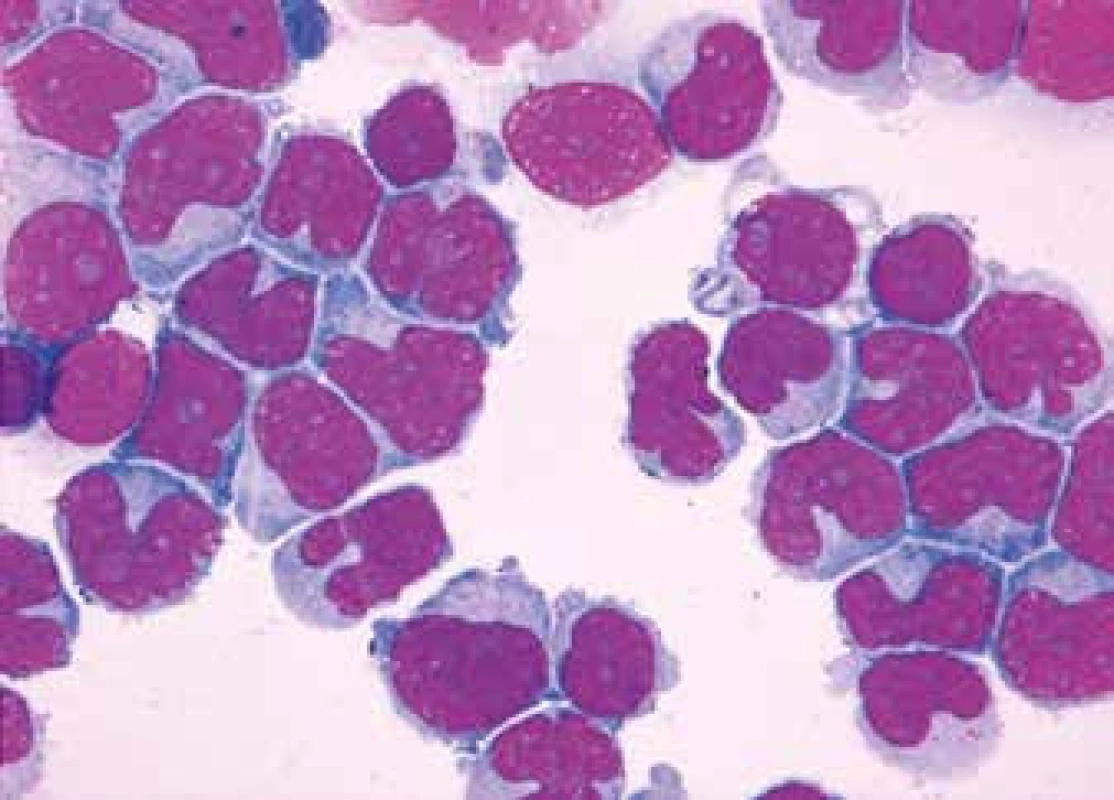 CD5+ MZL, pleomorfní obraz (středně velké anizomorfní lymfocyty s bohatou 
a nepravidelnou bazofilní cytoplazmou, méně kondenzovaným jaderným chromatinem a zřetelnými vícečetnými nukleoly a mikronukleoly)