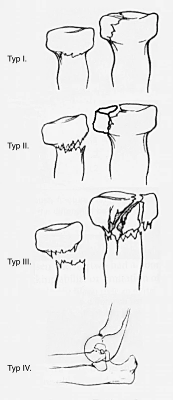 Masonova klasifikácia zlomenín hlavičky a krčku radia modifikovaná Brobergom a Morreyom. 
Typ I.: zlomenina hlavičky alebo krčku s dislokáciou &lt;2 mm.
Typ II.: zlomenina hlavičky alebo krčku s dislokácia ≥2 mm a postihujúca ≥ 30 % kĺbnej plochy.
Typ III.: kominutívna zlomenina hlavičky alebo krčku.
Typ IV.: luxácia lakťa s niektorým vyššie uvedeným typom fraktúry