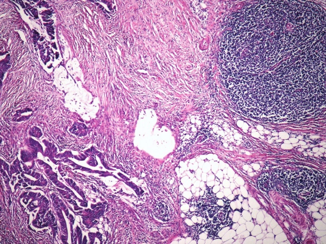 Kazuistika 2 – adenokarcinom tlustého střeva s navazující infiltrací malobuněčným B-lymfomem CLL/SLL (HE, 10x)
Fig. 4: Case 2 – colonic adenocarcinoma with subsequent infiltration by small cell B-cell lymphoma CLL/SLL (HE, 10x)