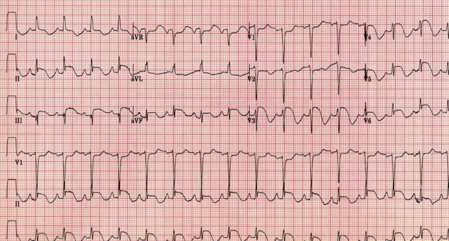EKG pacientky při přijetí