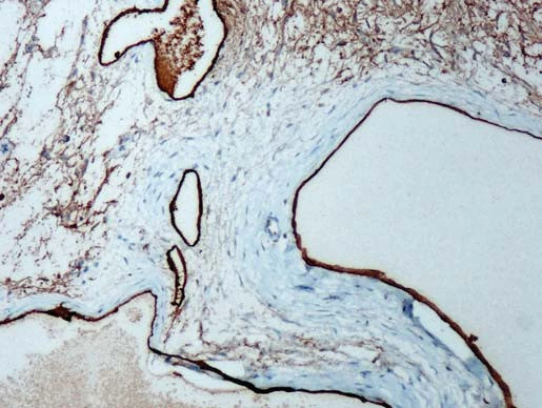 Imunohistologický průkaz znaku mezotelových buněk (Hector Battifora mesothelial cell 1).