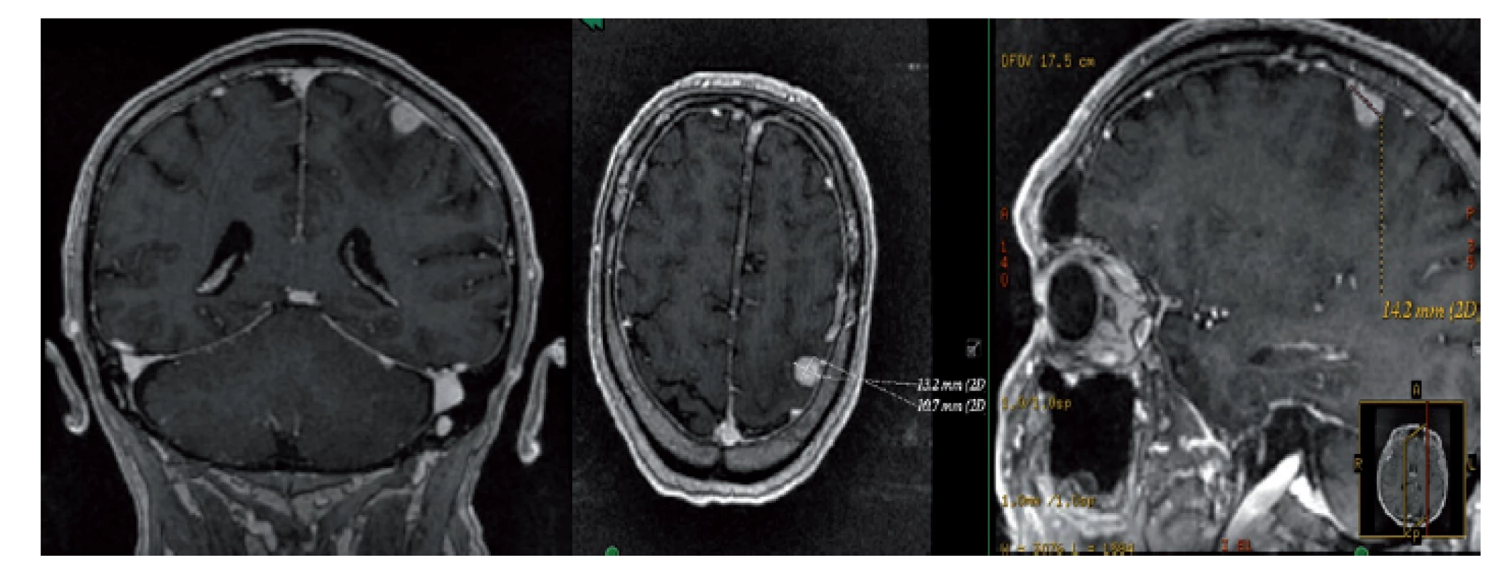 MRI mozku s nálezem supratentoriálně intraaxiálně
kortikálně v gyrus postcentralis vlevo solidního solitárního
ložiska charakteru metastázy