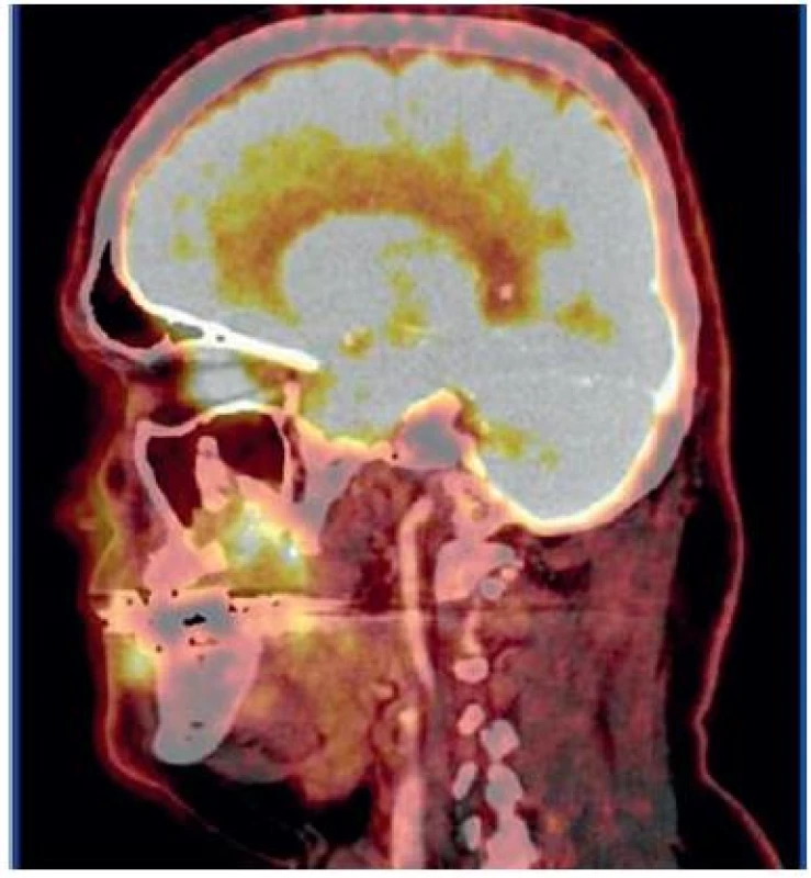 Sagitální PET CT řez