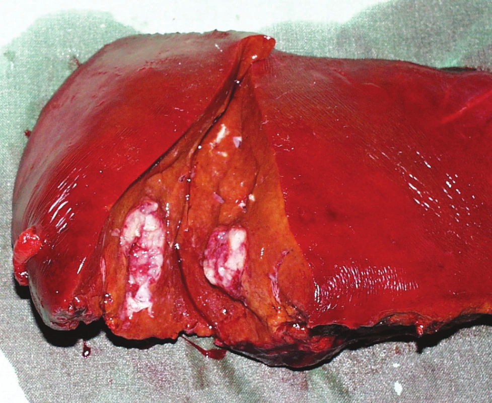 Metastáza karcinomu prsu v pravém jaterním laloku
Fig. 2. Breast carcinoma metastasis in the right liver lobe