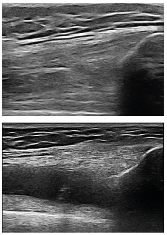 Ultrazvukový obraz suprapatelárního recesu kolenního kloubu.