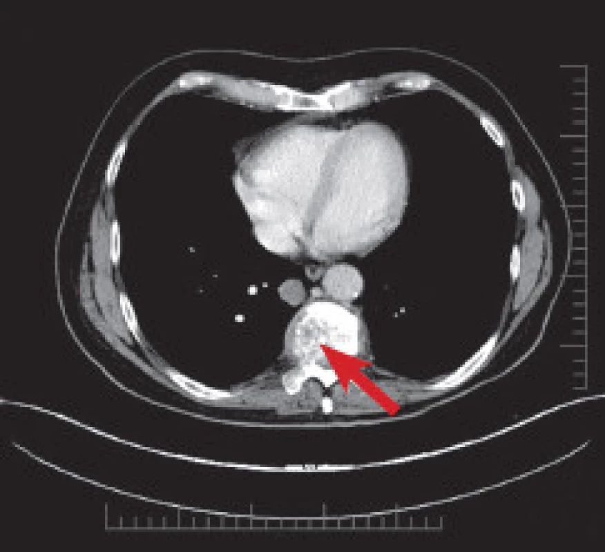 CT páteře v březnu 2013. Je patrná patologická fraktura obratlového těla Th9.