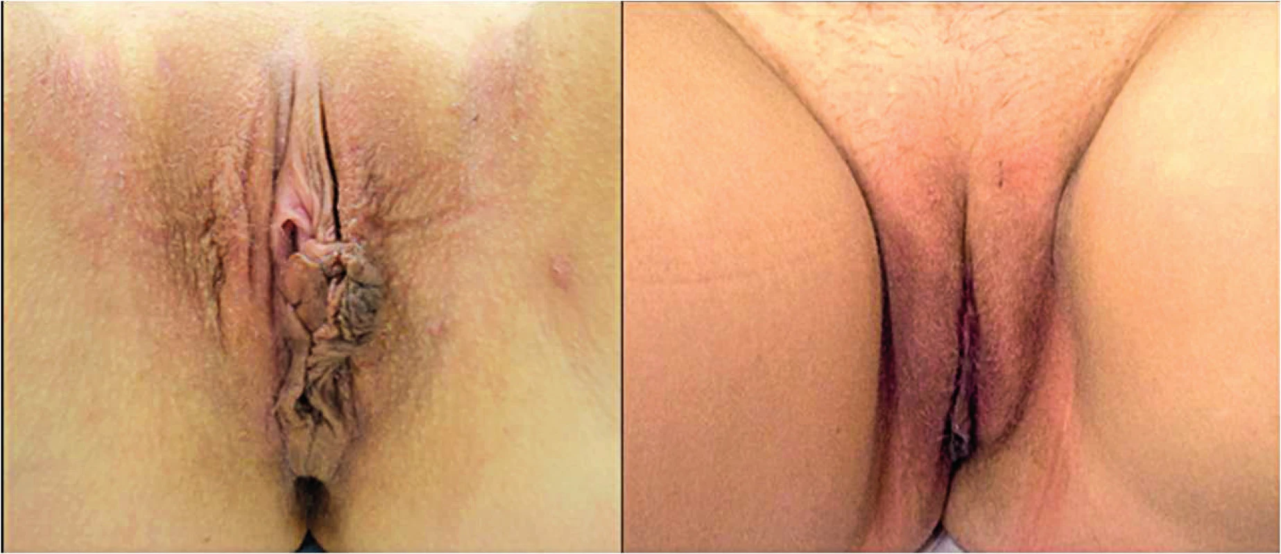 (Left) Preoperative view in a 34 years old patient. (Right) Post-operative view at 10 months