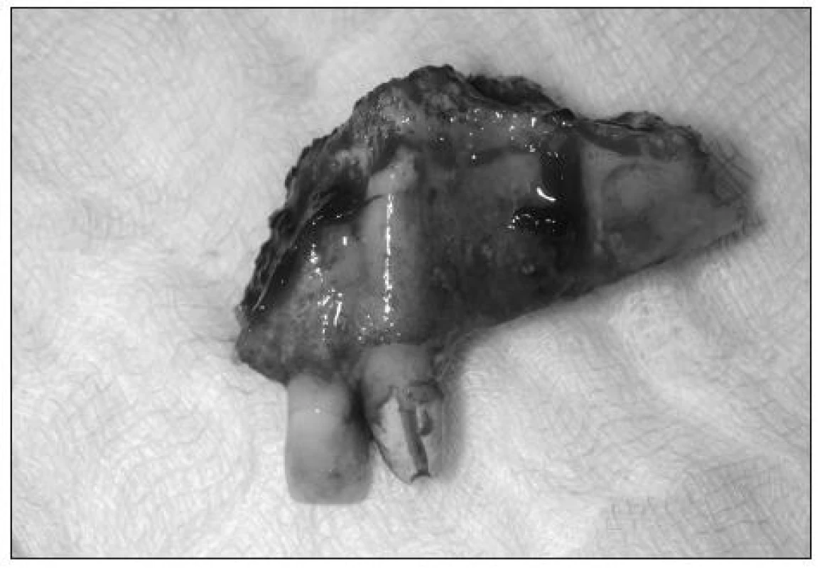Kostní resekát postižené části maxily.