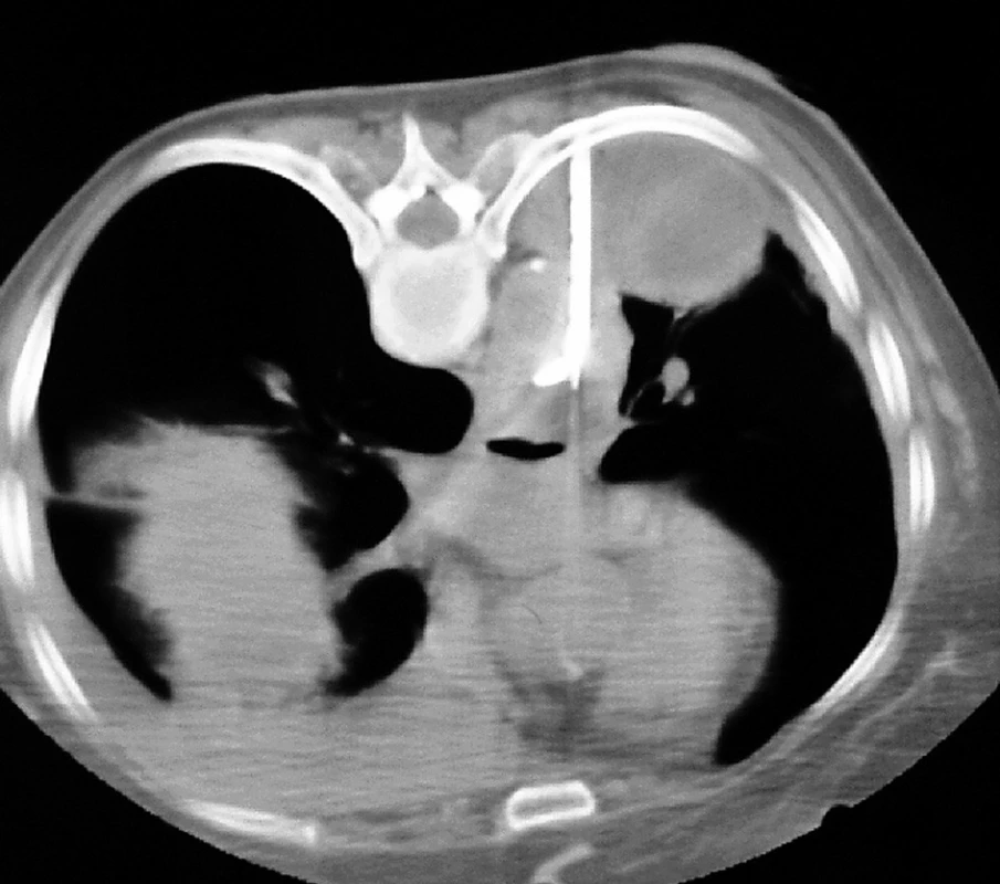 Chybné zavedení hrudního drénu: a) do plíce; b) přes aortu
Fig. 6: Misplacements of the chest drain: a) into the lung; b) through the aorta