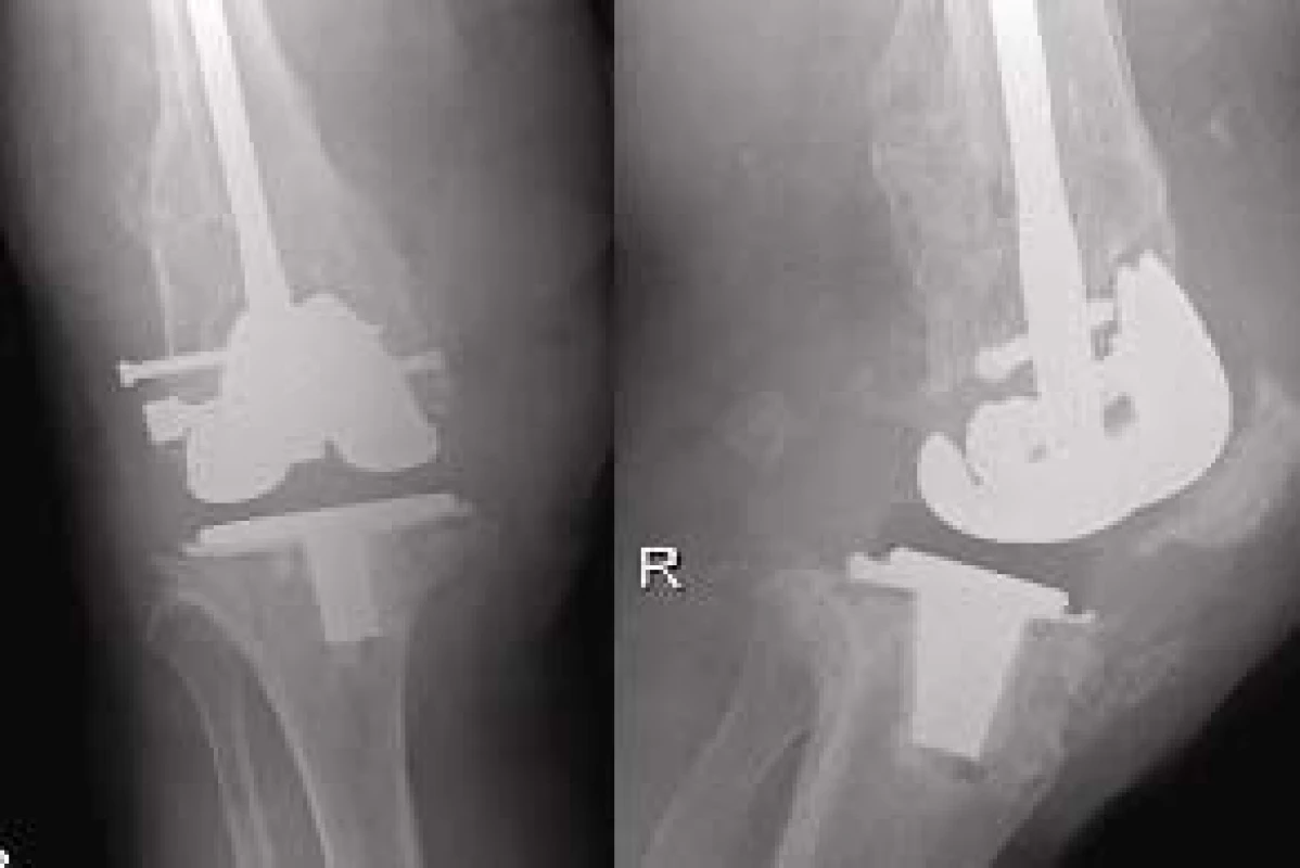 RTG dokumentace k uvedené pacientce před artrodézou a 5 let po osteosyntéze