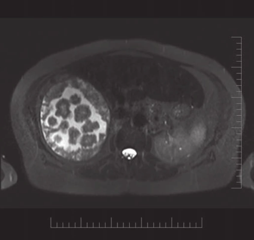 MRI snímky doplněné v MOÚ na přání infekcionisty, na snímcích jsou patrné echinokokové cysty.