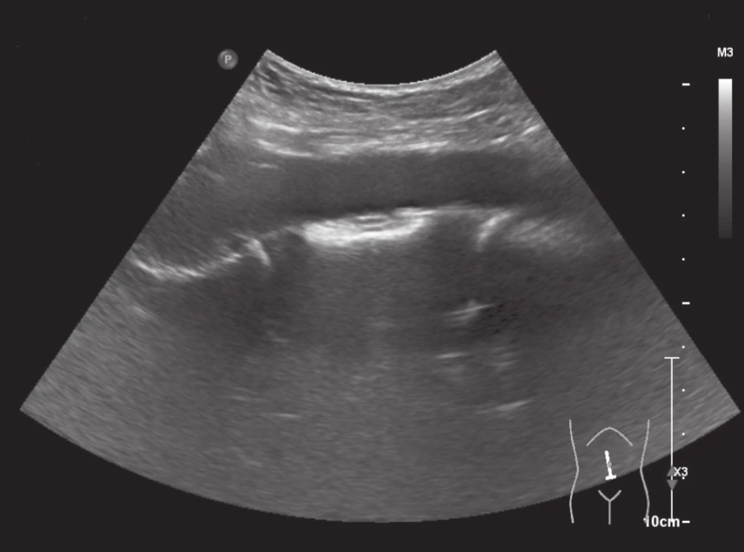 Ultrazvukový obraz vnitřní kýly
Fig. 1: Ultrasound image of internal hernia
