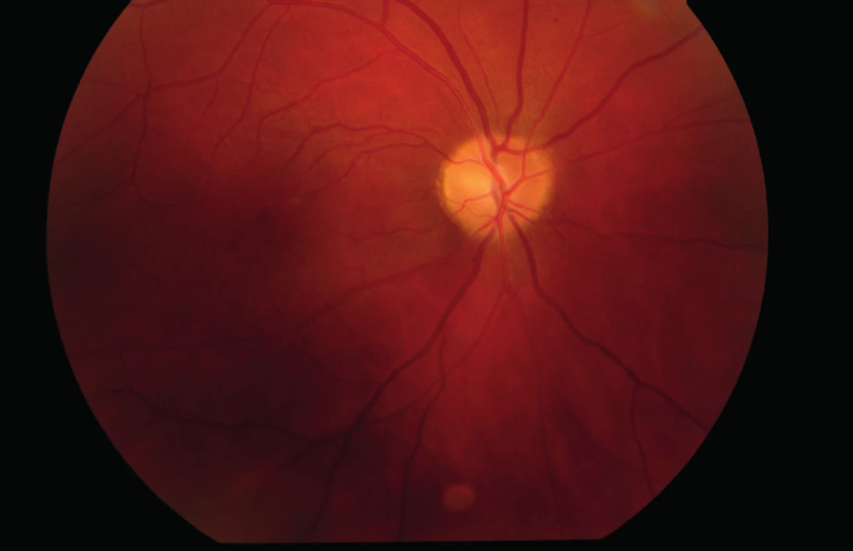 Očné pozadie pravého oka (4/2014) – bledšia papila zrakového nervu, stabilný stav.