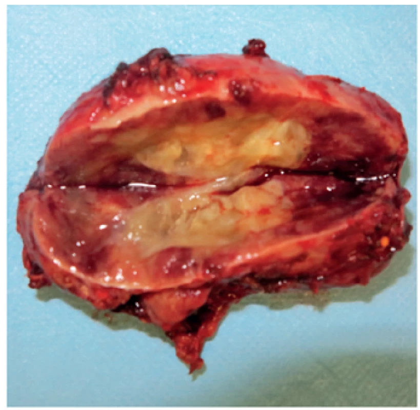Laparoskopicky extrahovaný feochromocytóm u 12-ročného pacienta s potvrdeným VHL syndrómom. Snímka laparoskopicky extrahovaného tumoru vľavo veľkosti 70 x 40 x 30 mm.
&lt;br&gt;&lt;b&gt;Fig. 3.&lt;/b&gt; Laparoscopically extracted pheochromocytoma in 12 years old patient with confirmed VHL syndrome. Photo of laparoscopically extracted left sided tumor 70 x 40 x 30 mm of size.