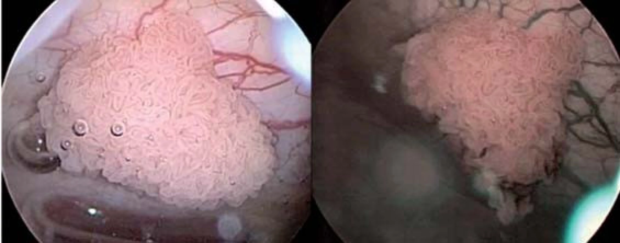 Obraz tumoru v konvenčním CSK obrazu vlevo a v NBI obrazu vpravo.