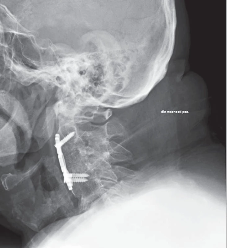 Kazuistika 1 – boční RTG snímek krční páteře 13 měsíců po operaci.
Srůst (fúze) C2–4, instrumentace titanovou dlahou a šrouby C2–4, vyrovnaná krční lordóza.