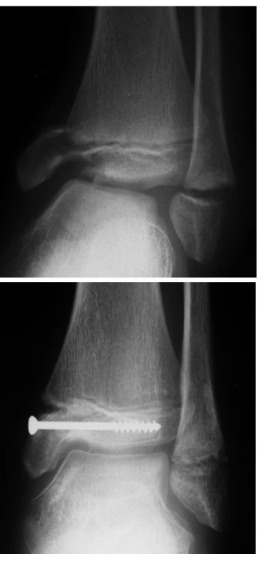 Zlomenina distální epifýzy tibie – vnitřního kotníku – typu Salter Harris III; separace distální epifýzy fibuly typu Salter Harris I: 
a) úrazový RTG snímek v AP projekci
b) RTG snímek po osteosyntéze tibie jedním šroubem transepifyzárně v AP projekci; fibula léčena pouze repozicí.