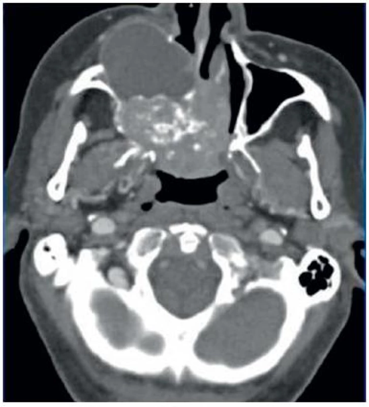 Axiální CT řez – tumor maxily s propagací do tváře a nosní dutiny