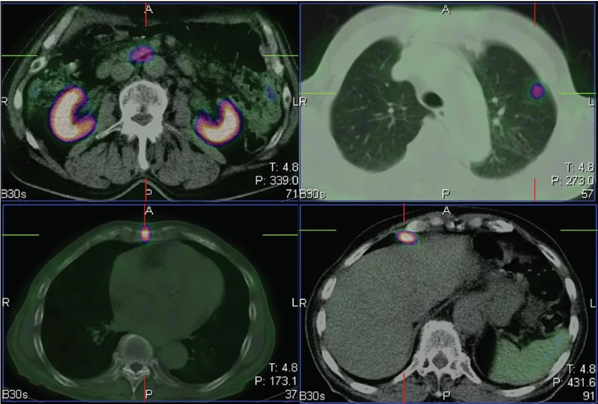 Na tomografických řezech viditelný primární tumor v kličce tenkého střeva (vlevo nahoře), ložisko v levé plíci (vpravo nahoře), ve sternu (vlevo dole) a v uzlině před játry (vpravo dole).