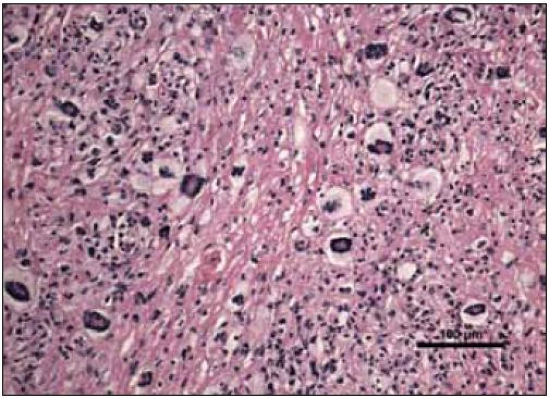 Barvení hematoxylin-eozin, původní zvětšení 200krát. Hustá zánětlivá infiltrace zahrnující jednojaderné histiocyty, často pěnité; a obrovské mnohojaderné buňky Toutonova typu. V centru mikrosnímku je oblast s hypereozinofilní (sytěji růžovou až červenou) mezibuněčnou hmotou, která odpovídá nekrobióze vaziva.