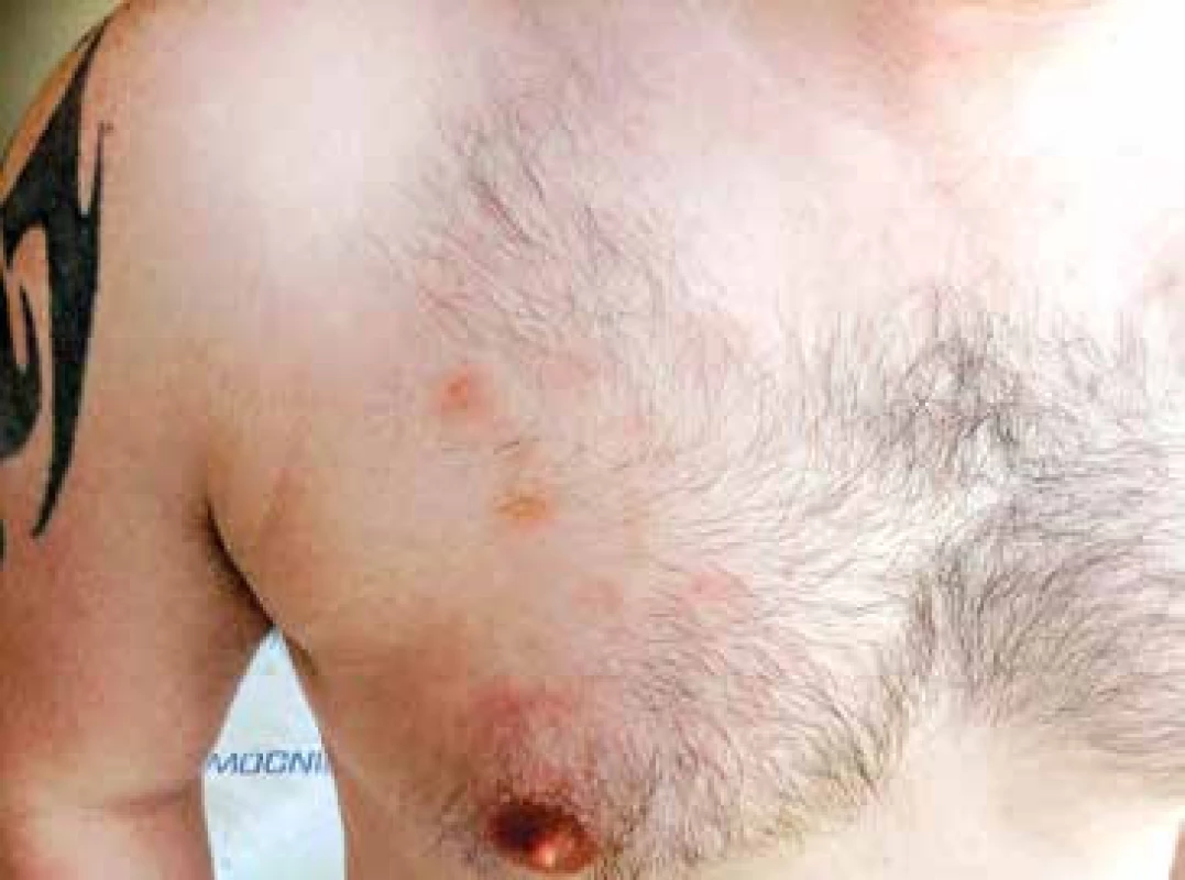 Detail kožní léze na trupu, stav po zahájení předfáze kortikosteroidy