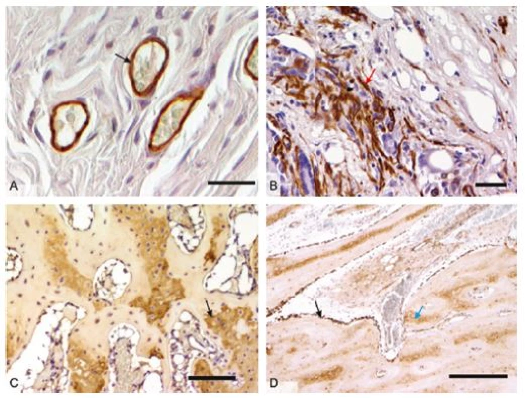 Mikrofotografie imunohistochemických preparátů orgánů z &lt;i&gt;in vivo&lt;/i&gt; hodnocení biomateriálů: 2A – průkaz endoteliálních buněk (černá šipka) při testování sítěk pro prevenci vzniku hiátové hernie v břišní stěně prasete, detekce pomocí protilátky anti-CD31, měřítko 50 μm; 2B – kontraktilní myofibroblasty (červená šipka) v břišní stěně prasete, detekce pomocí protilátky proti hladkosvalovému aktinu, měřítko 100 μm; 2C – průkaz kolagenu typu II v hyalinní chrupavce (černá šipka) diferencující se v osteochondrálním defektu kondylu femuru králíka, detekce pomocí protilátky proti-kolagenu II, měřítko 100 μm; 2D – průkaz kostního proteinu osteokalcinu v osteoblastech (černá šipka) a kostní matrix (modrá šipka) v osteochondrálním defektu u králíka, detekce pomocí protilátky anti-osteokalcin, měřítko 50 μm. U všech snímků vizualizace pomocí peroxidázové reakce a diaminobenzidinu, kontrabarvení jader Gillovým hematoxylinem.