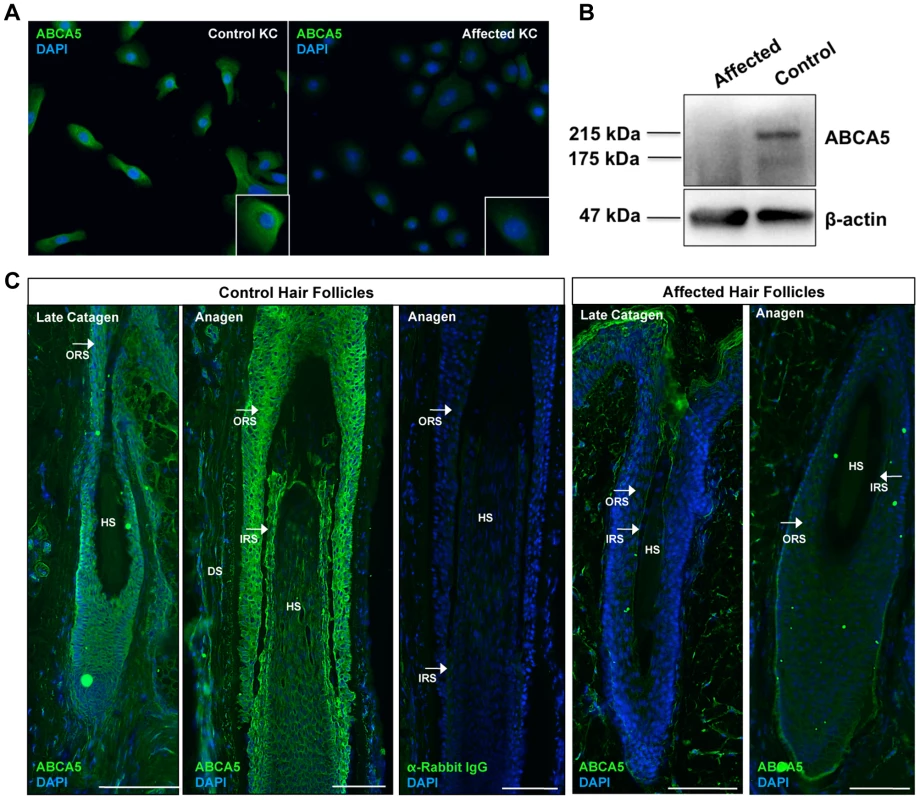 ABCA5 protein levels are significantly reduced in CGHT patient keratinocytes and hair follicles.