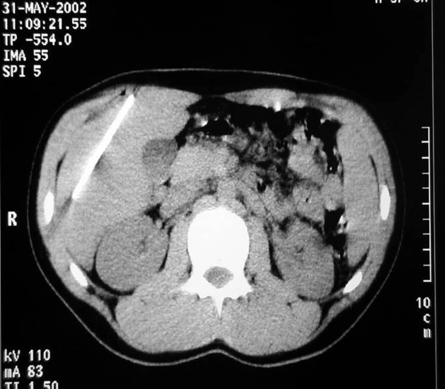 Na CT viditelné cizí těleso (střep) v pravém jaterním laloku
Fig. 2: CT, visible foreign object (glass fragment) in the right liver lobe