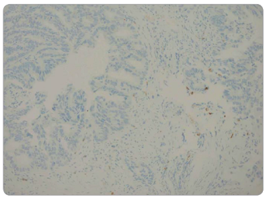 Nízká hustota CD8&lt;sup&gt;+&lt;/sup&gt; TIL v předléčebné endobiopsii, imunohistochemická pozitivita CD8, zvětšeno 200x.