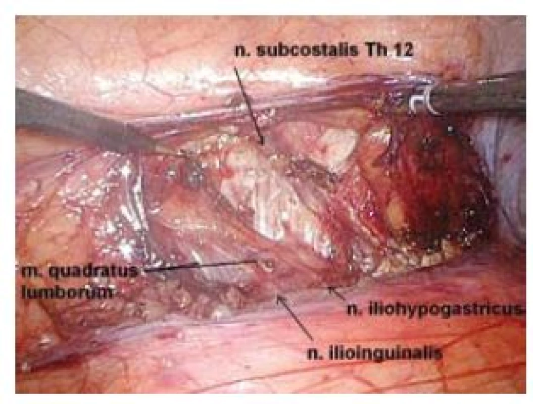 Zadní peritoneum otevřené v Toldtově linii laterálně od pravé ledviny, lze diferencovat nervy patrné na obrázku 1
Fig. 2. Peritoneum is incised laterally from the right kidney in Toldt’s line. The nerves showed on figure 1 are clearly visible.