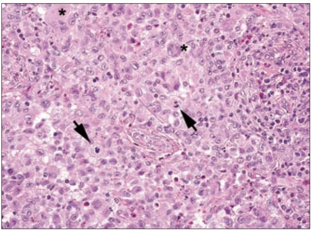 Langerhansovy buňky při velkém zvětšení. Je patrné, že mají eozinofilní cytoplazmu, indentovaná jádra. Objevují se i mnohojaderné formy (označeny hvězdičkami). V tomto zorném poli jsou zachyceny dvě mitózy (šipky), což je jev spíše ojedinělý.