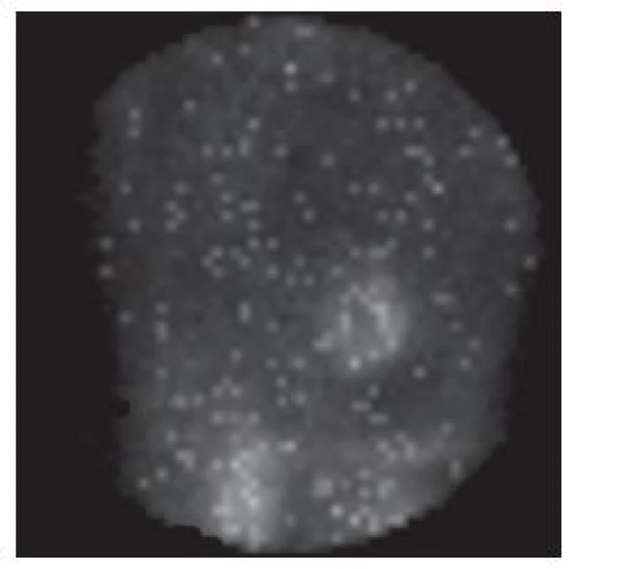 Vybraný snímek tomografické studie s „problikáváním“. Objevuje se při prohlížení nasnímaných dat v cine formátu u synchronizovaného záznamu, pokud je v některých fázových obrazech zaznamenán malý počet impulzů.