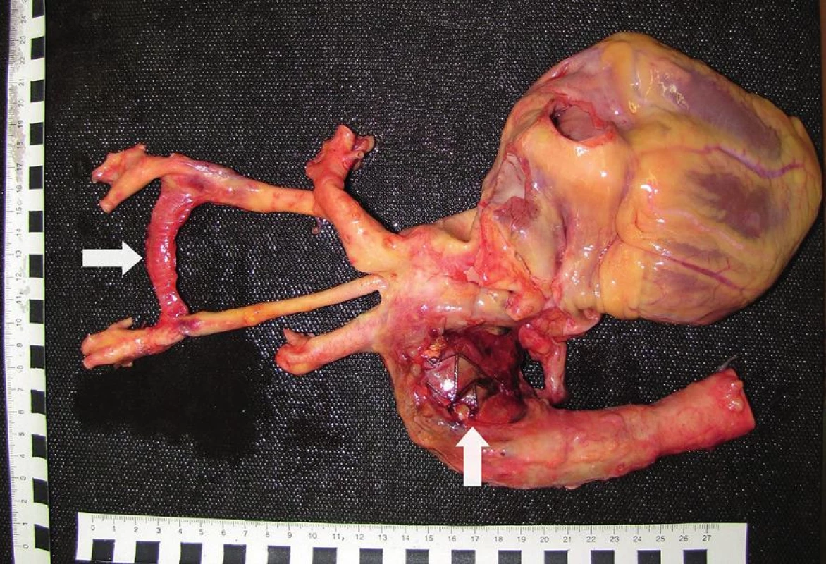 Srdce, aorta a jej hlavné odstupy pri pohľade zozadu. Prítomný defekt descendentnej aorty 
s presvitajúcim aortálnym stentgraftom (zvislá šípka) a karotickokarotickým bypassom (vodorovná šípka).