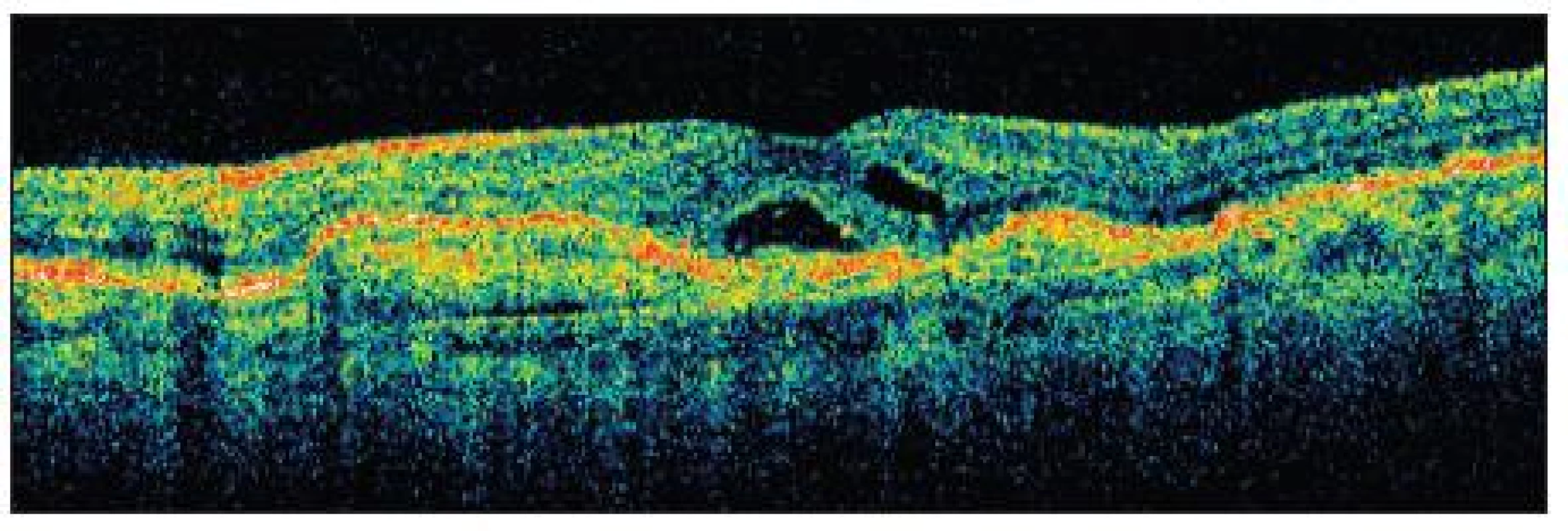 OCT ľavého oka po prvej aplikácii anti-VEGF. Zmenšenie subretinálneho edému a normalizácie hrúbky sietnice v makulárnej krajine. Pretrváva malá ablácia neuroretiny