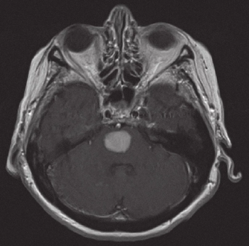 Magnetická rezonance, SE MTC T1 s kontrastní látkou i.v. Pacientka C. R. 1934, kontrastně se sytící infiltrát v mozkovém kmeni při záchytu lymfomu.