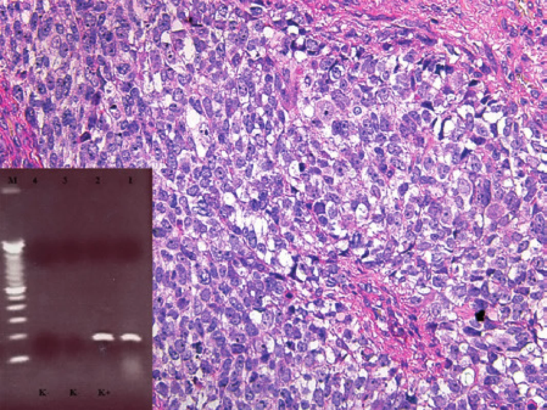 Kazuistika 6. Rabdomyosarkom, v tomto případě alveolární se solidními oblastmi. Bez dalších vyšetřovacích postupů by nádor nebylo možné jednoznačně klasifikovat. Barveno hematoxylinem a eozinem (původní zvětšení 100x). Vložený obrázek: Agarózový gel s detekcí fúzního genu PAX3/FOXO1, který je produktem translokace t(2;13). Zprava: 1. pacientka s RMS, 2. pozitivní kontrola RT-PCR, 3. negativní kontrola RT, 4. negativní kontrola PCR, M - 100 bp velikostní marker.