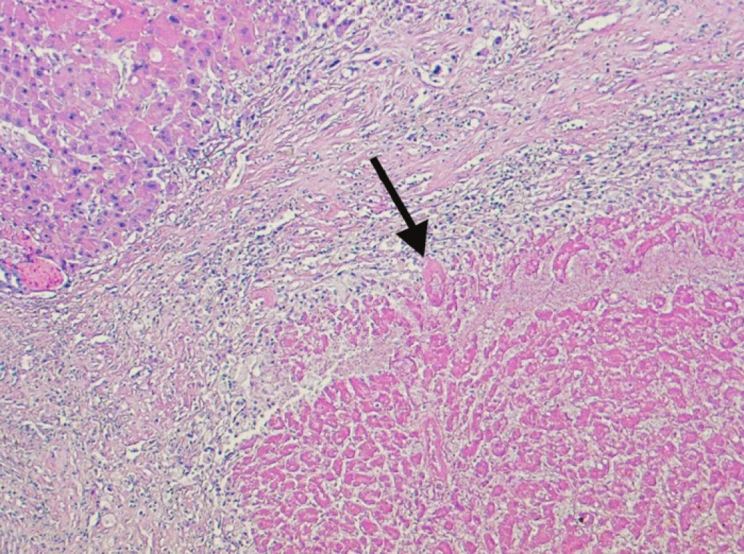 Kompletně nekrotický úsek tkáně nádoru (šipka). Nekróza je obklopená reaktivním lemem vazivové tkáně, vlevo nahoře je část cirhotického uzlu bez nádoru (100x, H&amp;E)
Fig. 4. Completely necrotized region of the tumor tissue (arrow). The necrosis is surrounded by a reactive rim of fibrous tissue, in the left upper corner, a cirrhotic, tumor-free bundle can be seen (100x, H&amp;E)
