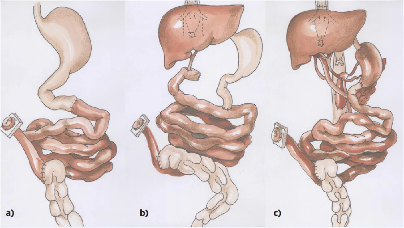 Schéma transplantace střeva:
a) izolovaná transplantace střeva
b) transplantace střeva a jater
c) multiviscerální transplantace