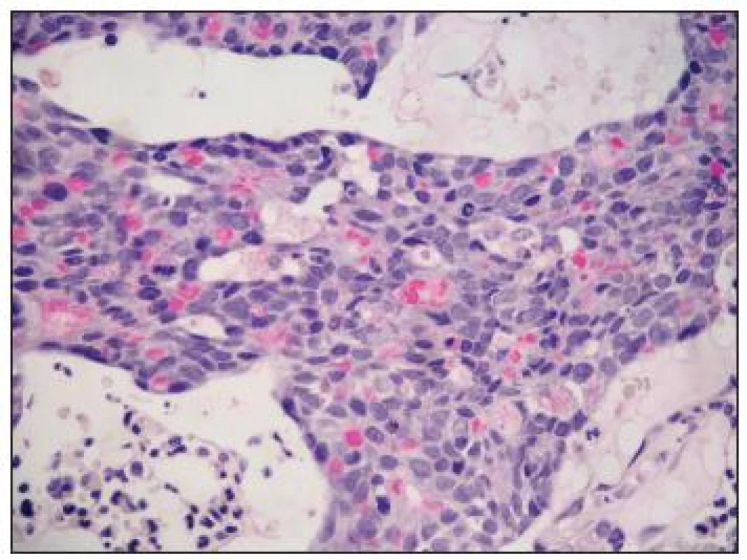 V cytoplazmě nádorových buněk byla často prokázána hlenotvorba. Trepanobiopsie, barvení mucikarmínem, velké zvětšení.