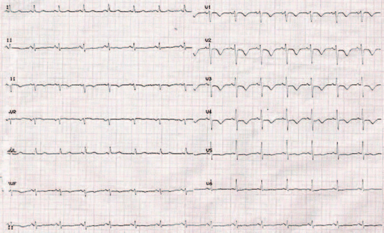 EKG záznam 48 hod po liečbe.