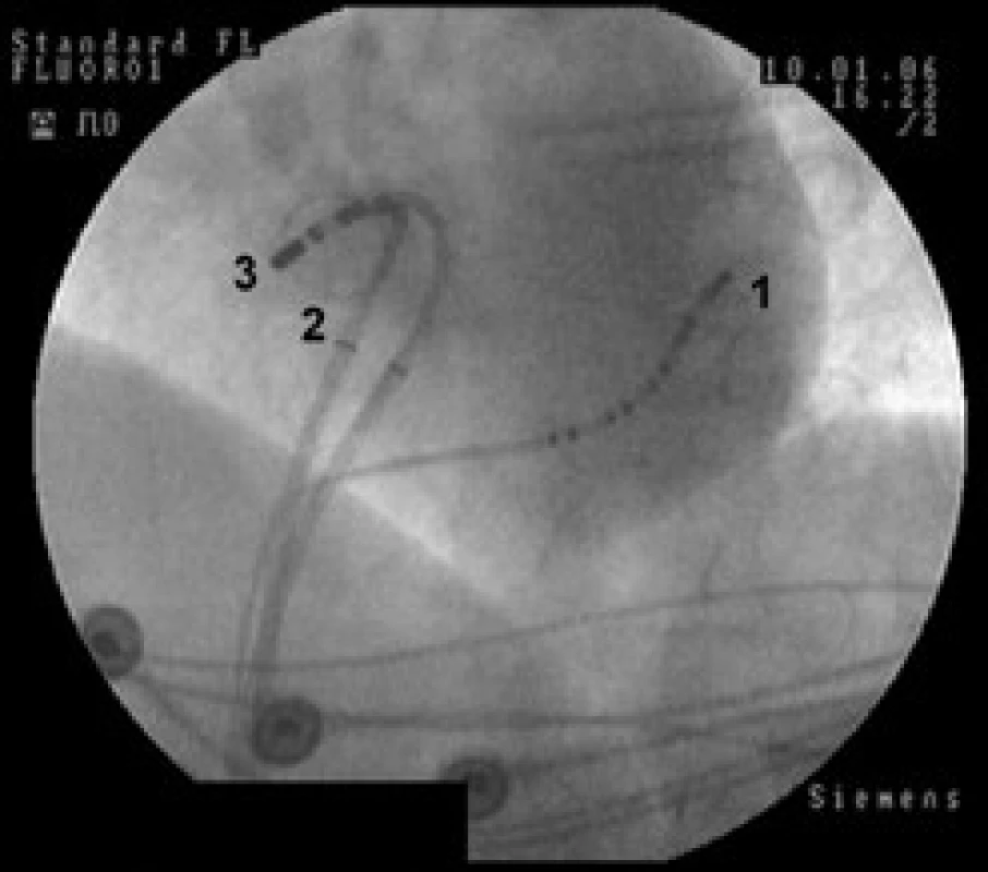 RTG snímek srdce v levé šikmé projekci.

