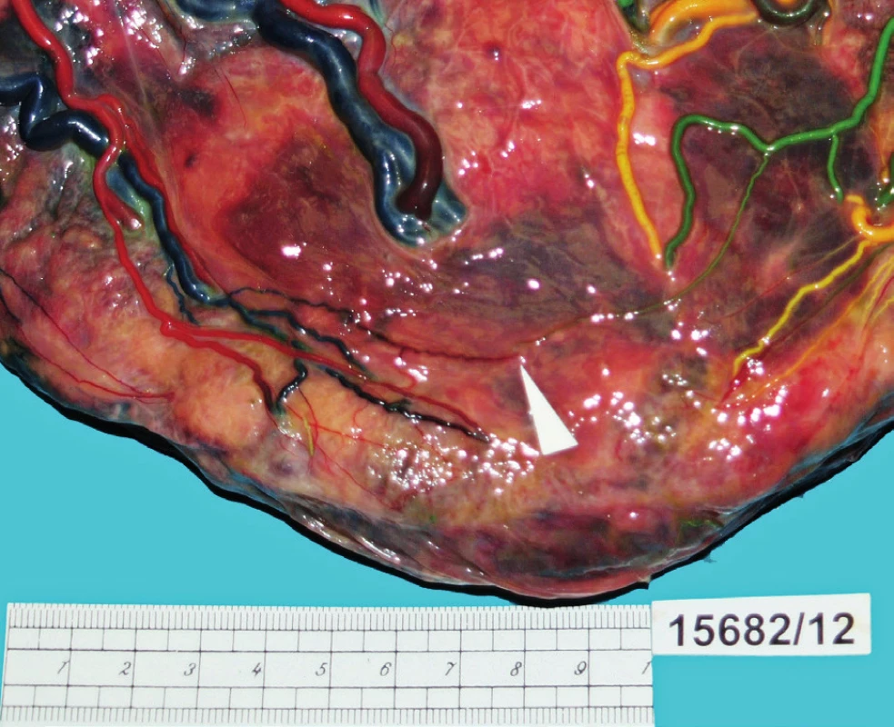 Barvení cévního řečiště placenty u případu spontánního TAPS (případ A). Detail drobné A–V anastomózy o průměru &lt; 1 mm.